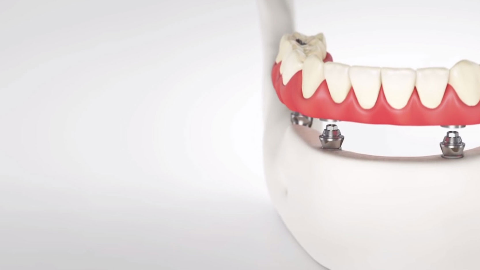 Full-Arch Dental Implants Fort Wayne, IN