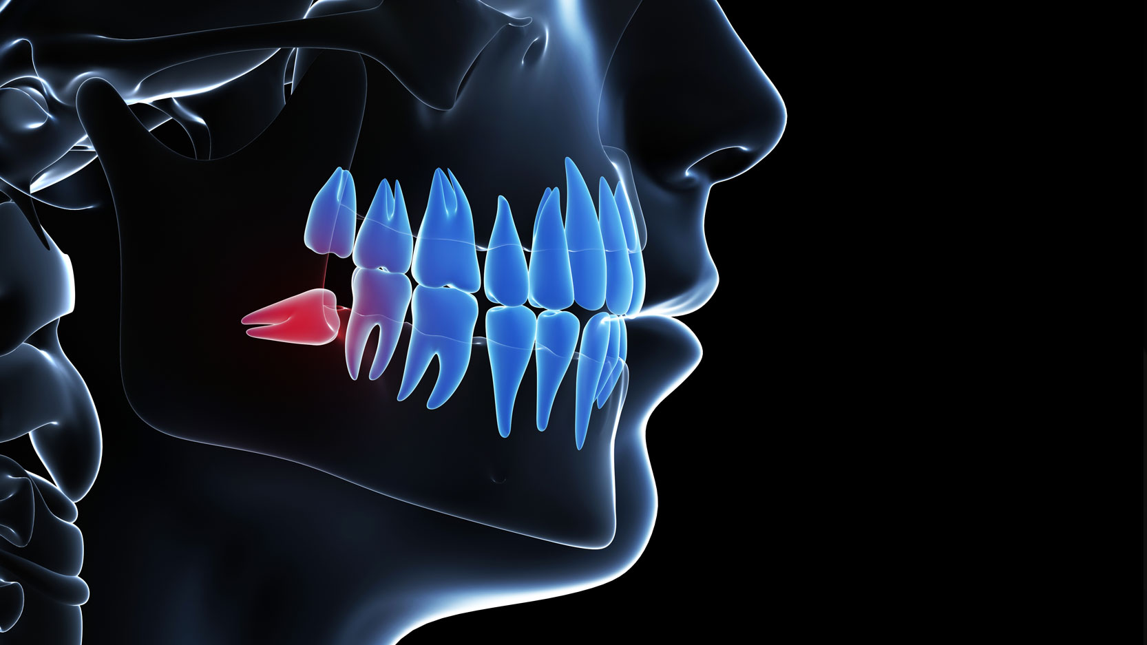 Wisdom Teeth Extraction Fort Wayne In Pain Free Treatment