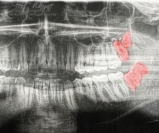 Wisdom Teeth Extractions Fort Wayne, IN